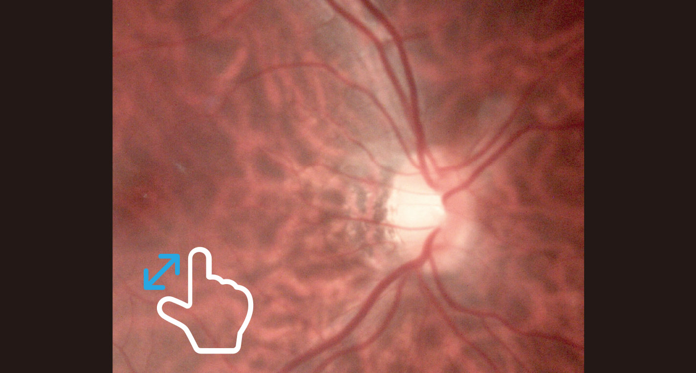 FC161 Hand-held Funduscamera