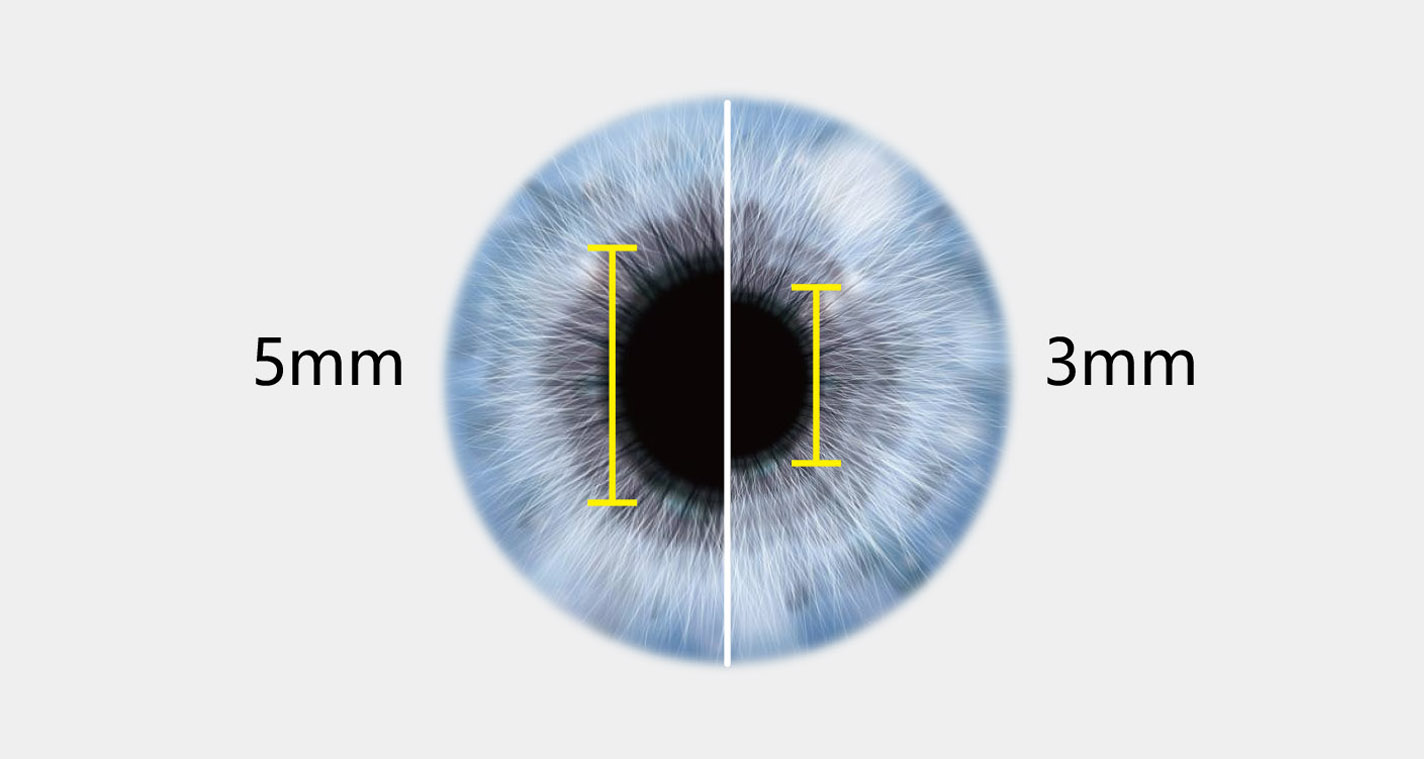 FC161 Hand-held Funduscamera