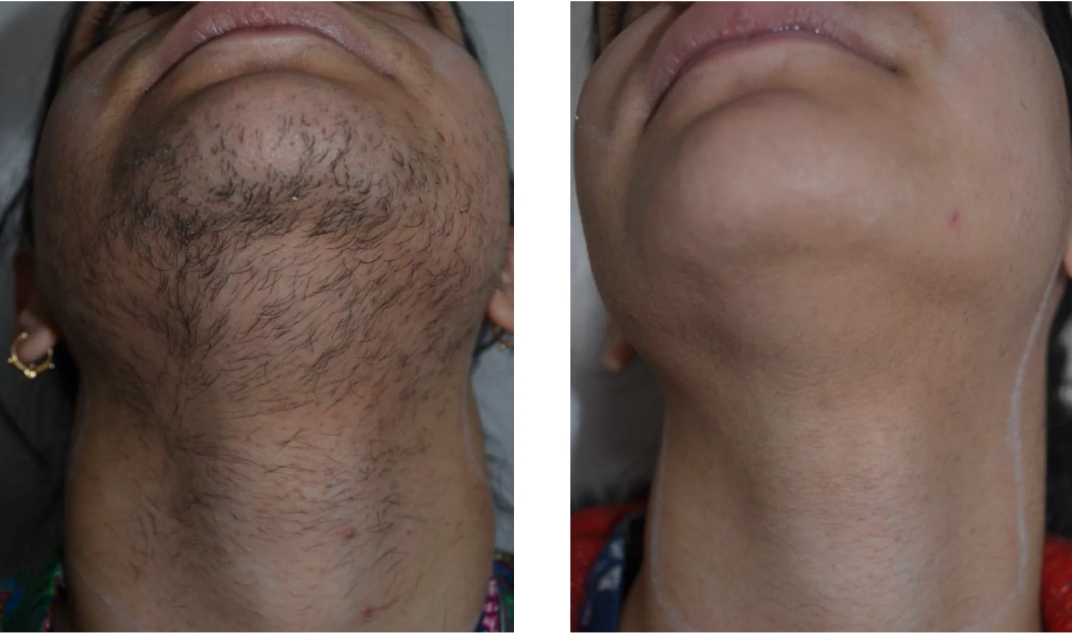 Wavemed Modula IPL
