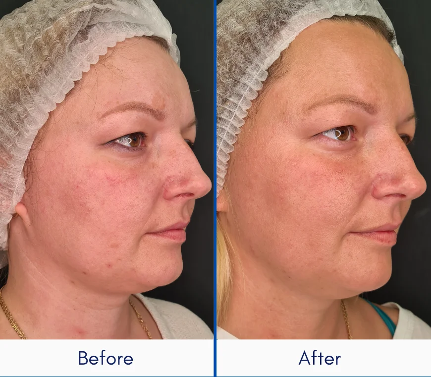Wavemed Modula IPL